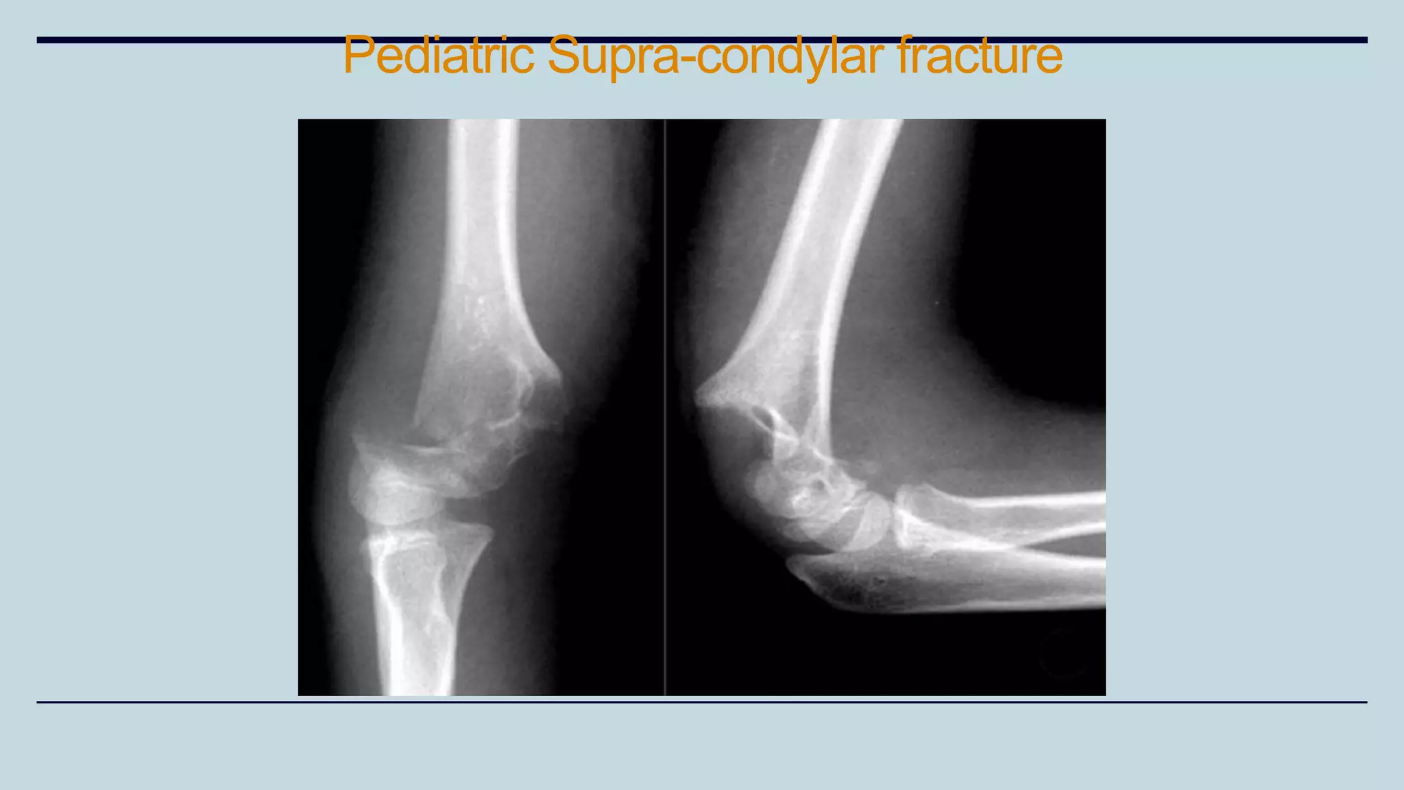 Pediatric Supra-condylar fracture
 