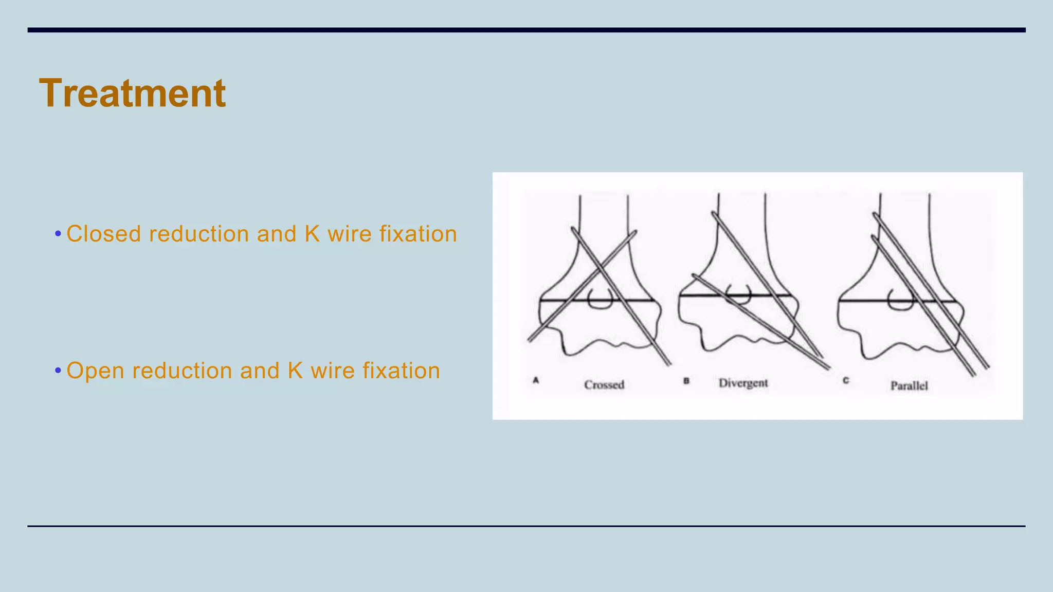 Treatment
• Closed reduction and K wire fixation
• Open reduction and K wire fixation
 