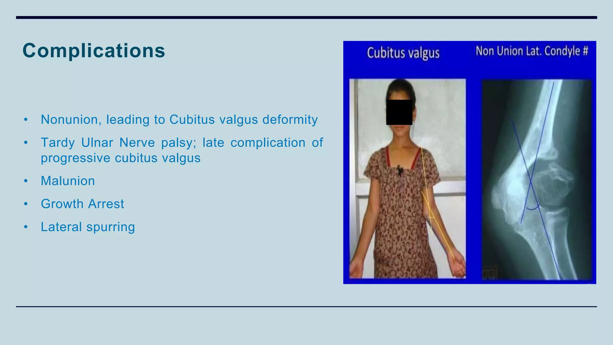 Complications
• Nonunion, leading to Cubitus valgus deformity
• Tardy Ulnar Nerve palsy; late complication of
progressive cubitus valgus
• Malunion
• Growth Arrest
• Lateral spurring
 