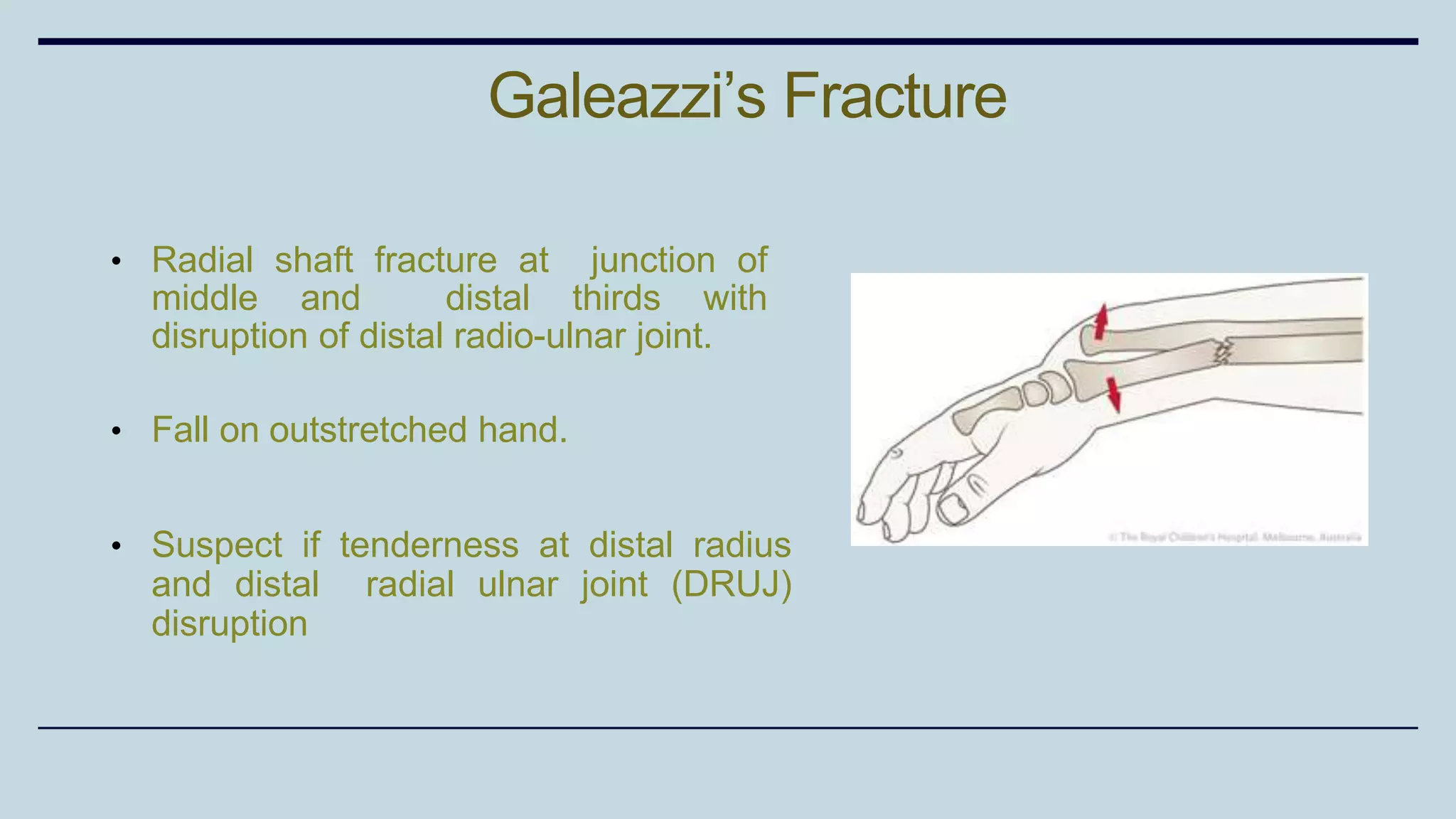 • Radial shaft fracture at junction of
middle and distal thirds with
disruption of distal radio-ulnar joint.
• Fall on outstretched hand.
• Suspect if tenderness at distal radius
and distal radial ulnar joint (DRUJ)
disruption
Galeazzi’s Fracture
 