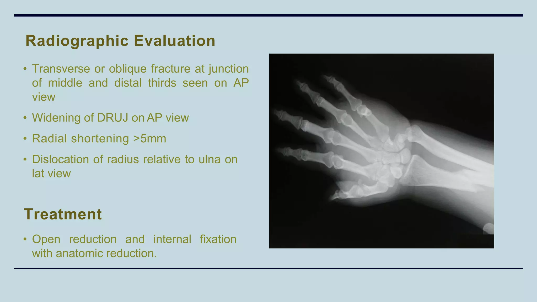 • Transverse or oblique fracture at junction
of middle and distal thirds seen on AP
view
• Widening of DRUJ on AP view
• Radial shortening >5mm
• Dislocation of radius relative to ulna on
lat view
Radiographic Evaluation
Treatment
• Open reduction and internal fixation
with anatomic reduction.
 