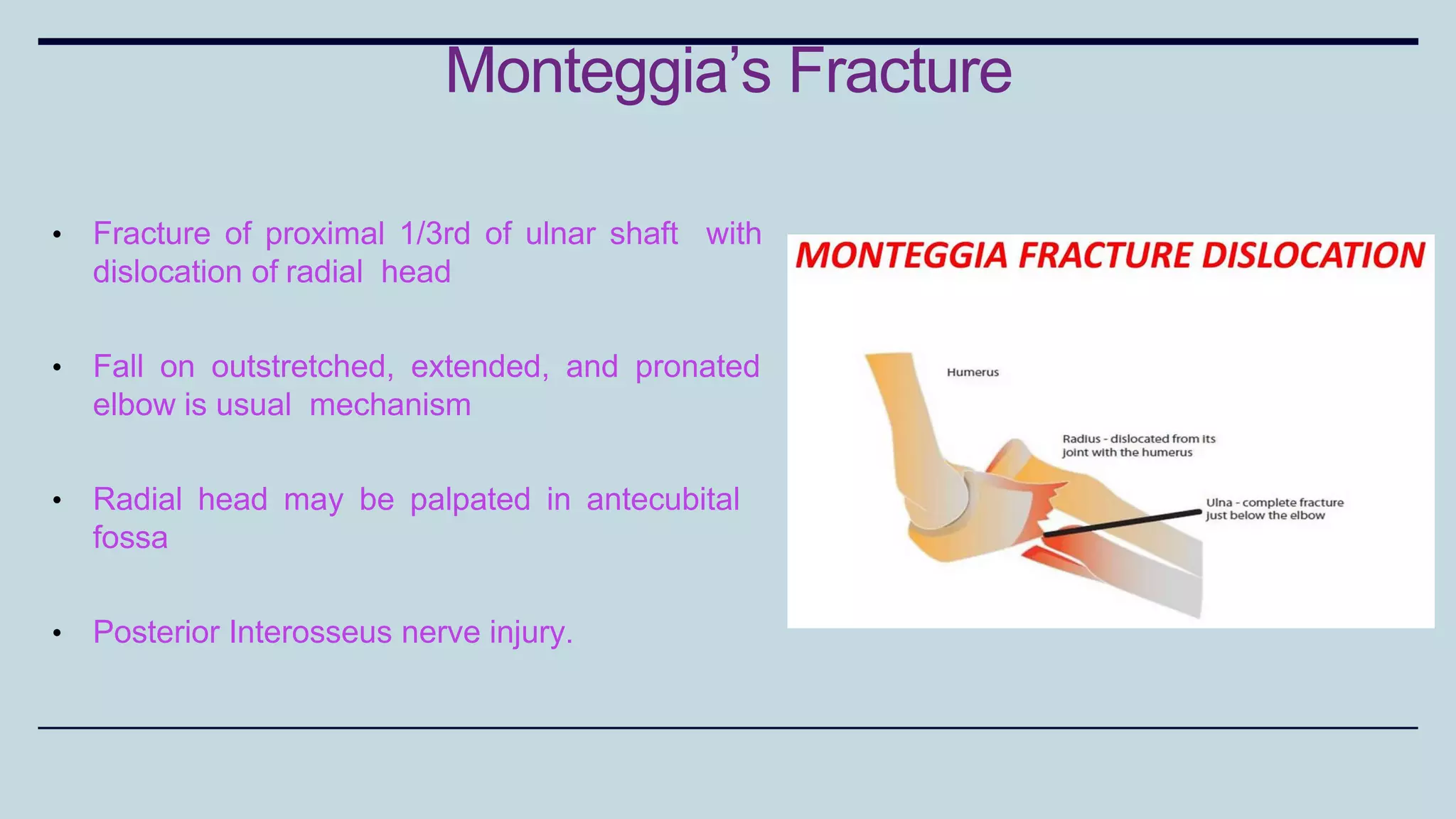 • Fracture of proximal 1/3rd of ulnar shaft with
dislocation of radial head
• Fall on outstretched, extended, and pronated
elbow is usual mechanism
• Radial head may be palpated in antecubital
fossa
• Posterior Interosseus nerve injury.
Monteggia’s Fracture
 