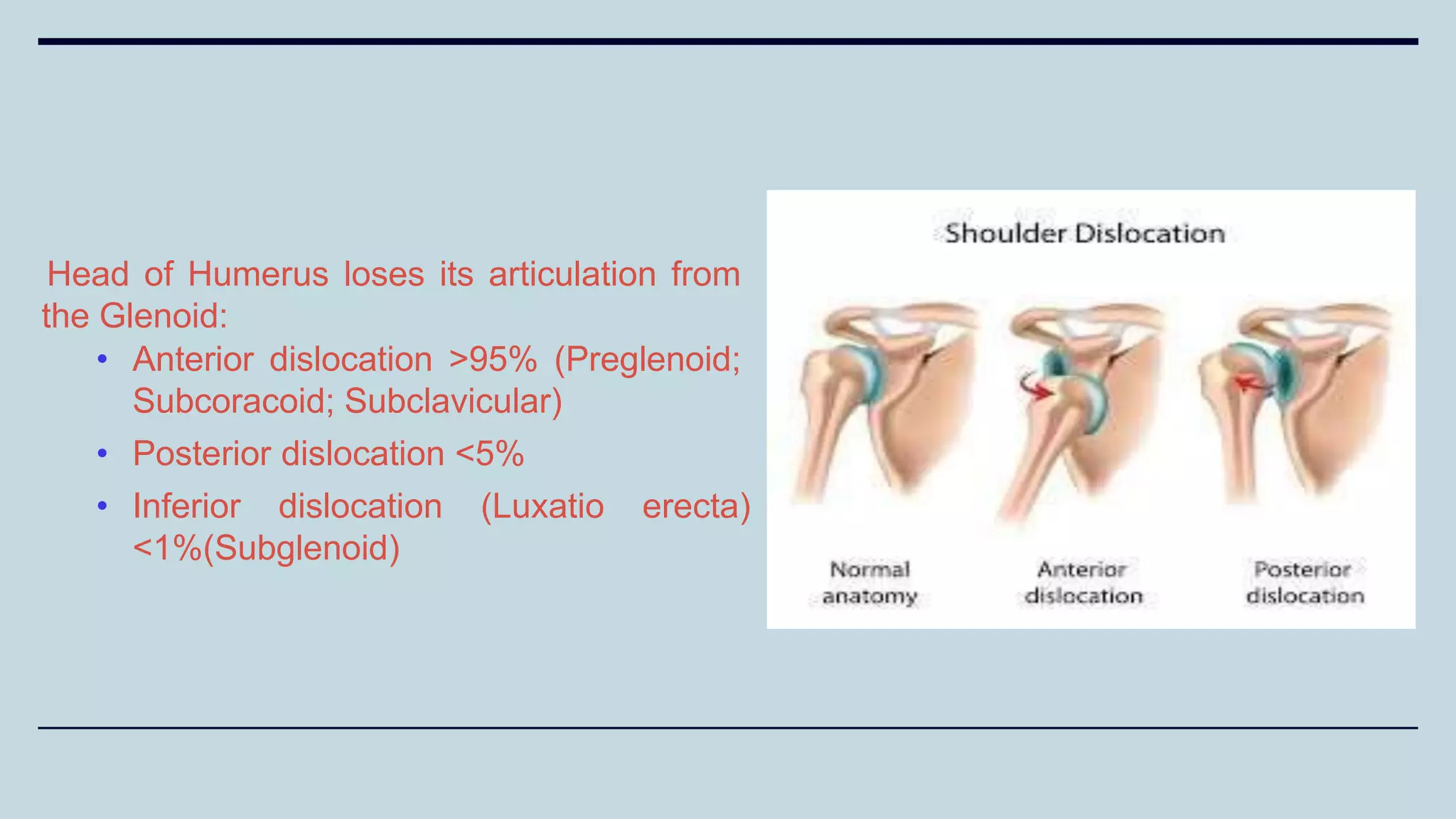 Head of Humerus loses its articulation from
the Glenoid:
• Anterior dislocation >95% (Preglenoid;
Subcoracoid; Subclavicular)
• Posterior dislocation <5%
• Inferior dislocation (Luxatio erecta)
<1%(Subglenoid)
 