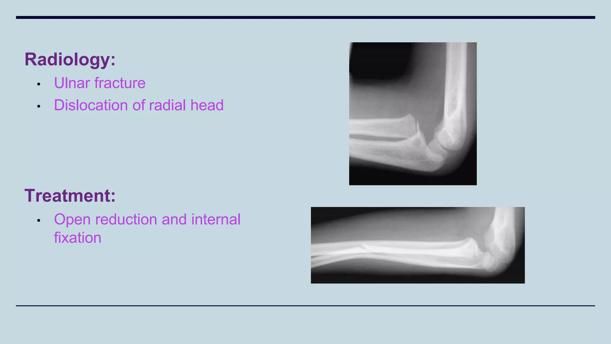 Radiology:
• Ulnar fracture
• Dislocation of radial head
Treatment:
• Open reduction and internal
fixation
 