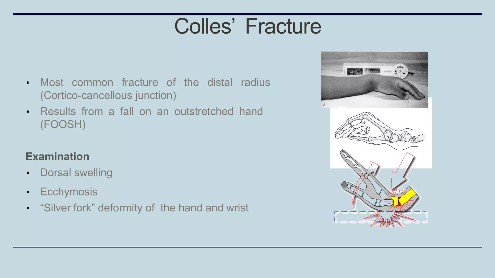 • Most common fracture of the distal radius
(Cortico-cancellous junction)
• Results from a fall on an outstretched hand
(FOOSH)
Examination
• Dorsal swelling
• Ecchymosis
• “Silver fork” deformity of the hand and wrist
Colles’ Fracture
 