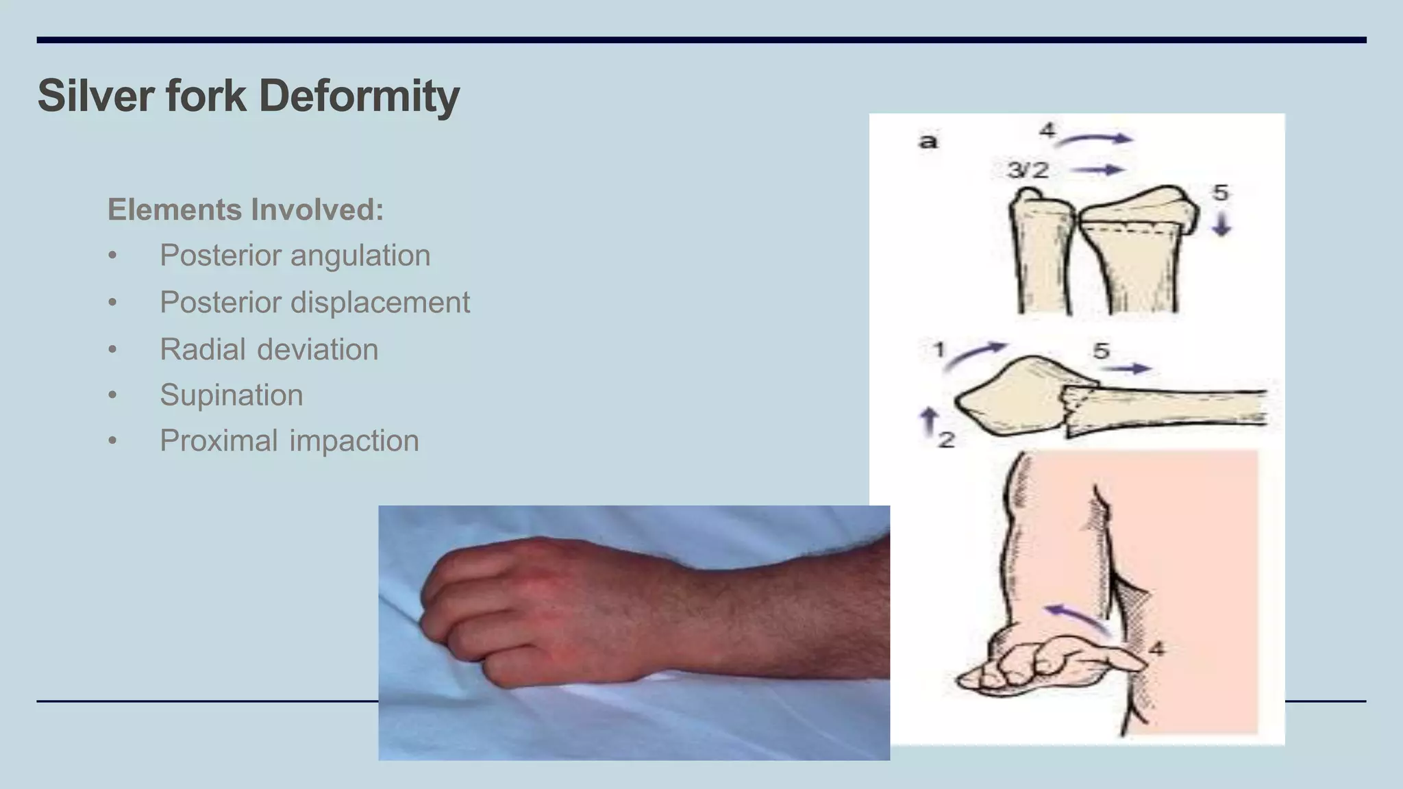 Elements Involved:
• Posterior angulation
• Posterior displacement
• Radial deviation
• Supination
• Proximal impaction
Silver fork Deformity
 