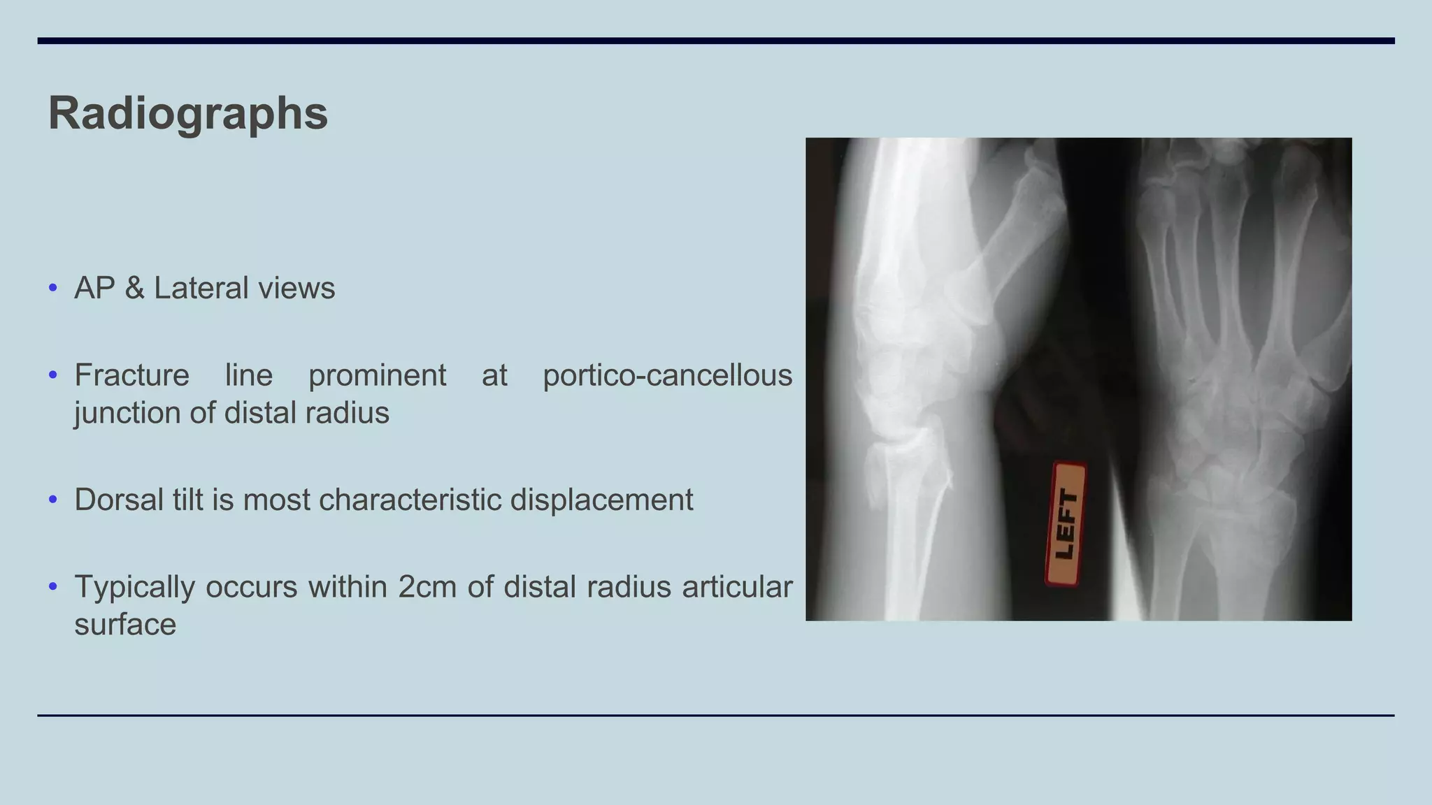 Radiographs
• AP & Lateral views
• Fracture line prominent at portico-cancellous
junction of distal radius
• Dorsal tilt is most characteristic displacement
• Typically occurs within 2cm of distal radius articular
surface
 