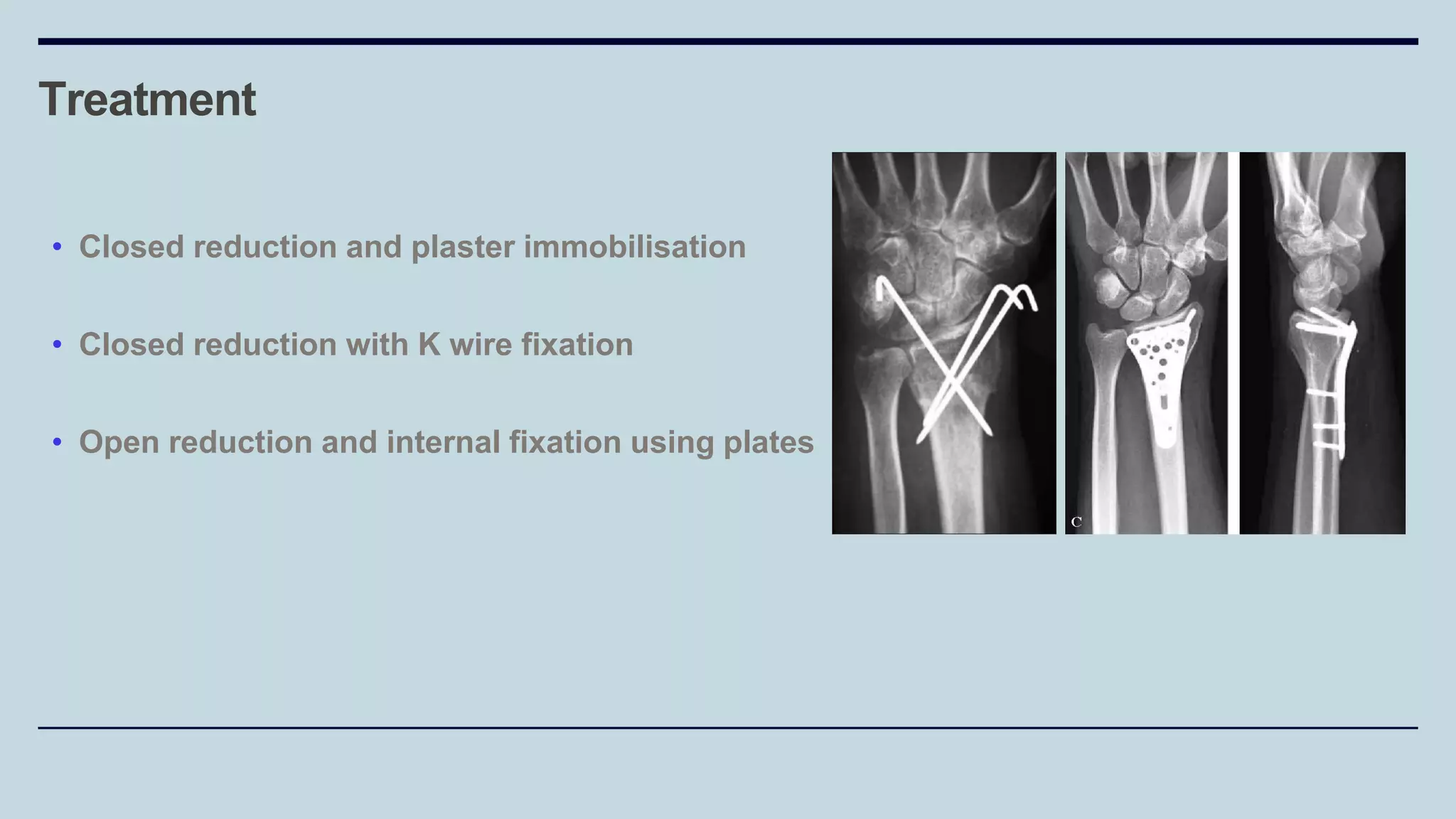 Treatment
• Closed reduction and plaster immobilisation
• Closed reduction with K wire fixation
• Open reduction and internal fixation using plates
 