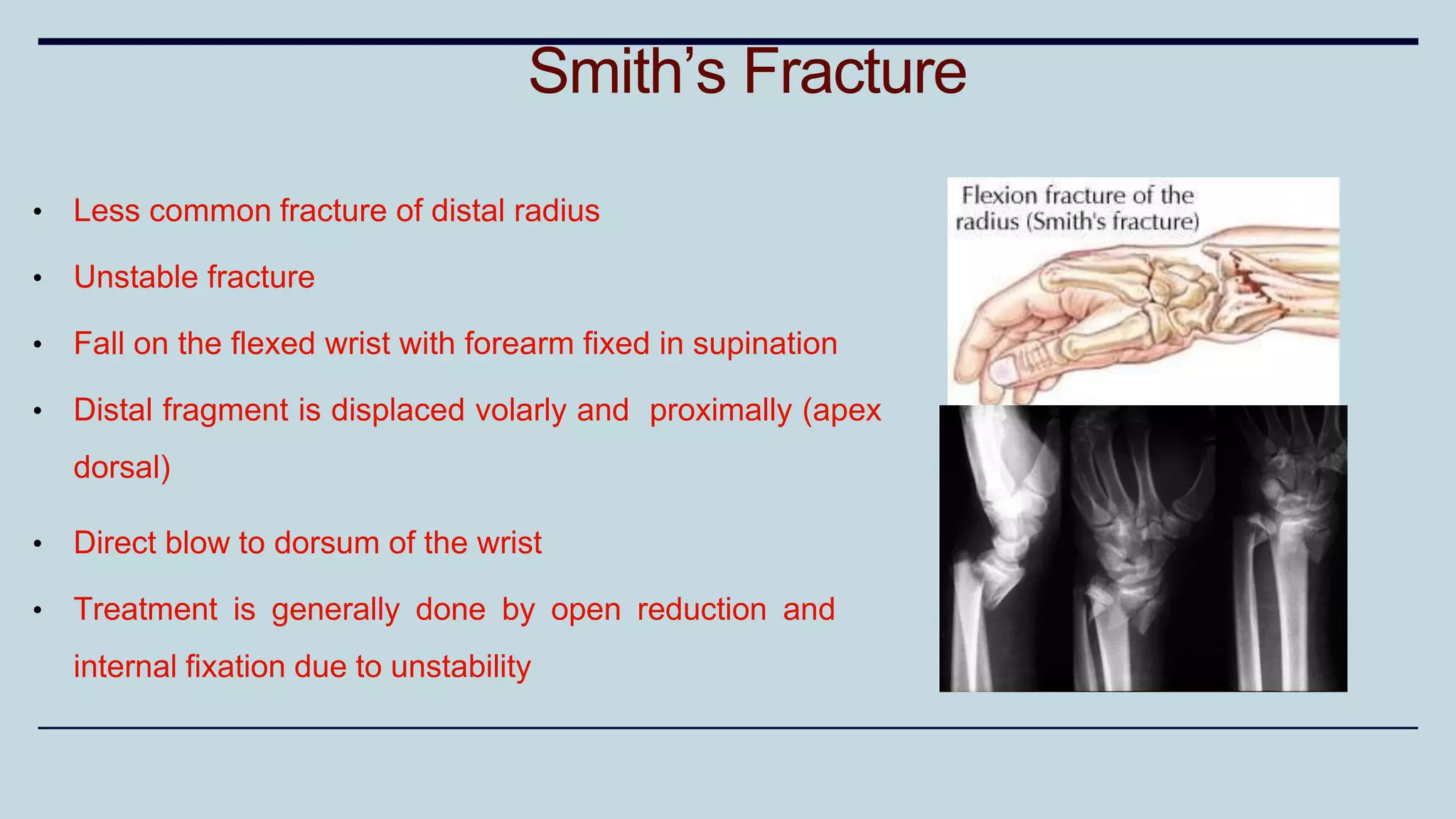 • Less common fracture of distal radius
• Unstable fracture
• Fall on the flexed wrist with forearm fixed in supination
• Distal fragment is displaced volarly and proximally (apex
dorsal)
• Direct blow to dorsum of the wrist
• Treatment is generally done by open reduction and
internal fixation due to unstability
Smith’s Fracture
 