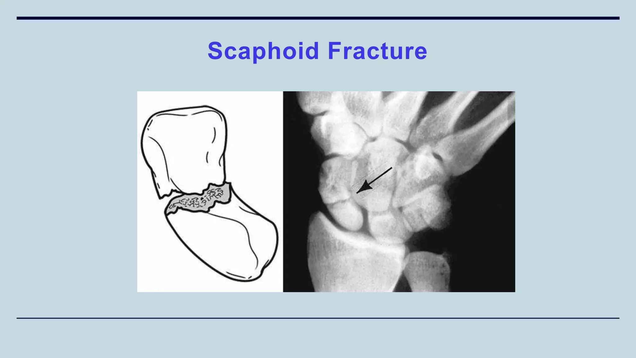 Scaphoid Fracture
 