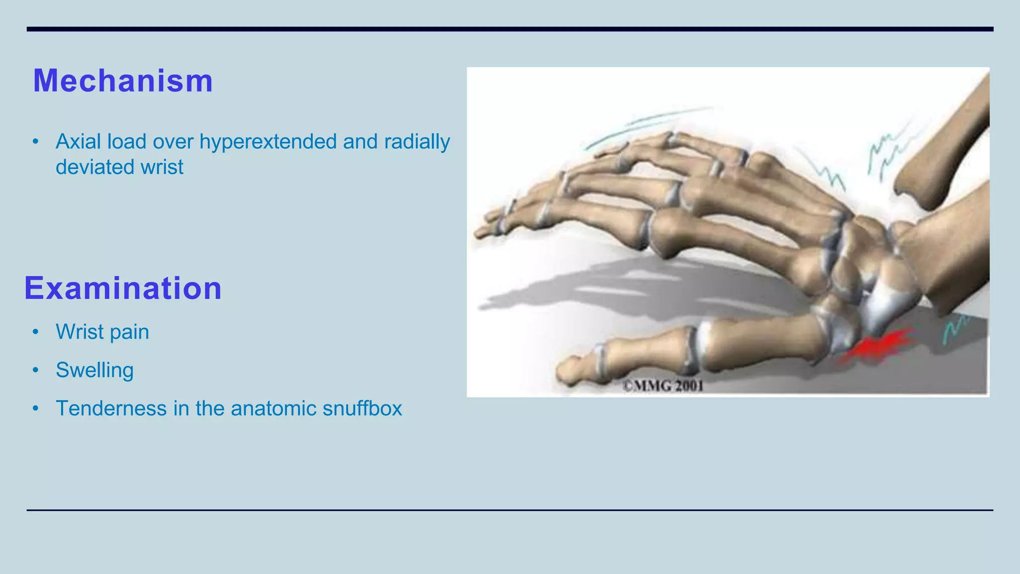 Mechanism
• Axial load over hyperextended and radially
deviated wrist
Examination
• Wrist pain
• Swelling
• Tenderness in the anatomic snuffbox
 