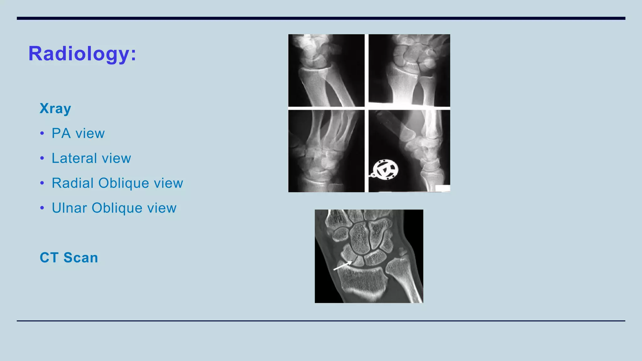 Xray
• PA view
• Lateral view
• Radial Oblique view
• Ulnar Oblique view
CT Scan
Radiology:
 