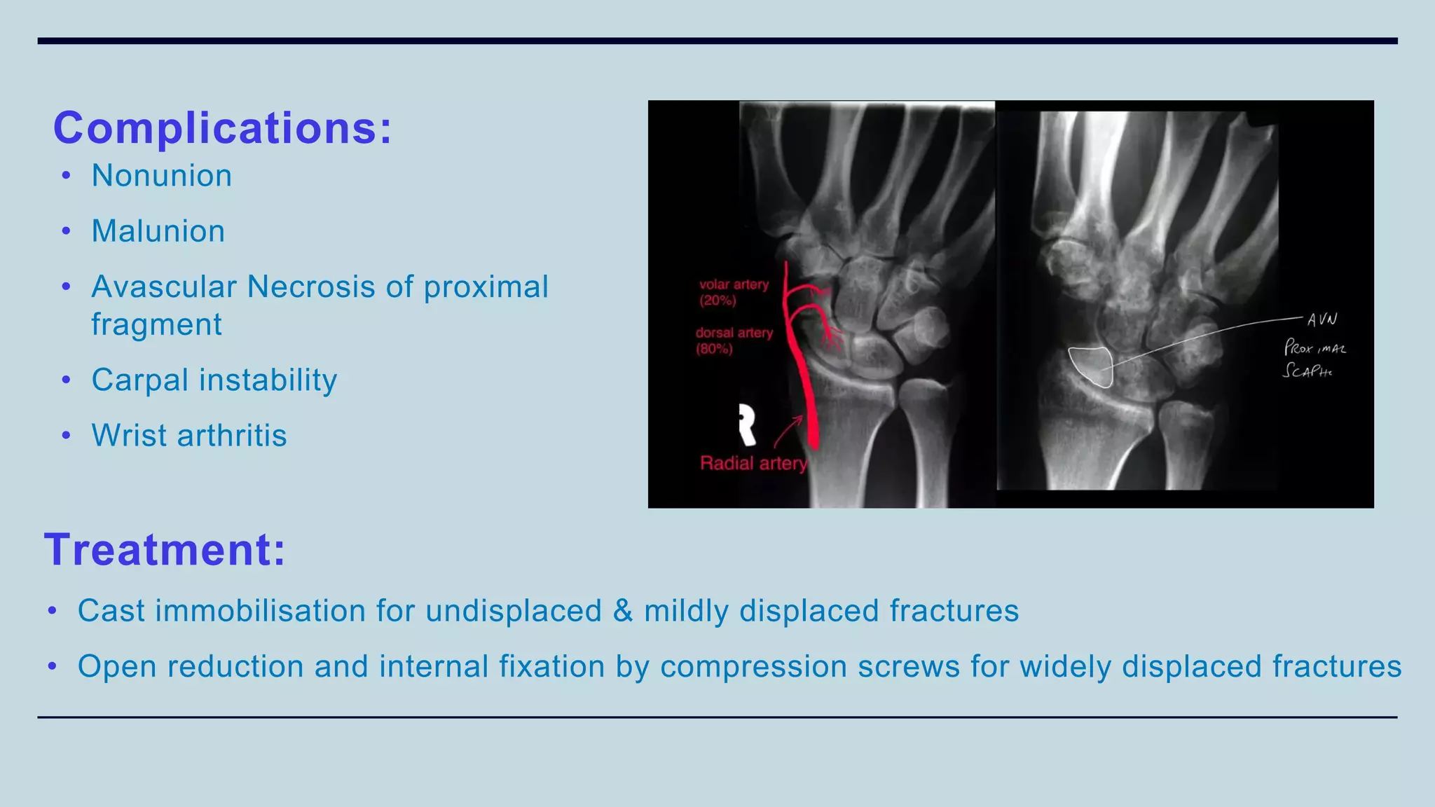 • Nonunion
• Malunion
• Avascular Necrosis of proximal
fragment
• Carpal instability
• Wrist arthritis
Complications:
Treatment:
• Cast immobilisation for undisplaced & mildly displaced fractures
• Open reduction and internal fixation by compression screws for widely displaced fractures
 