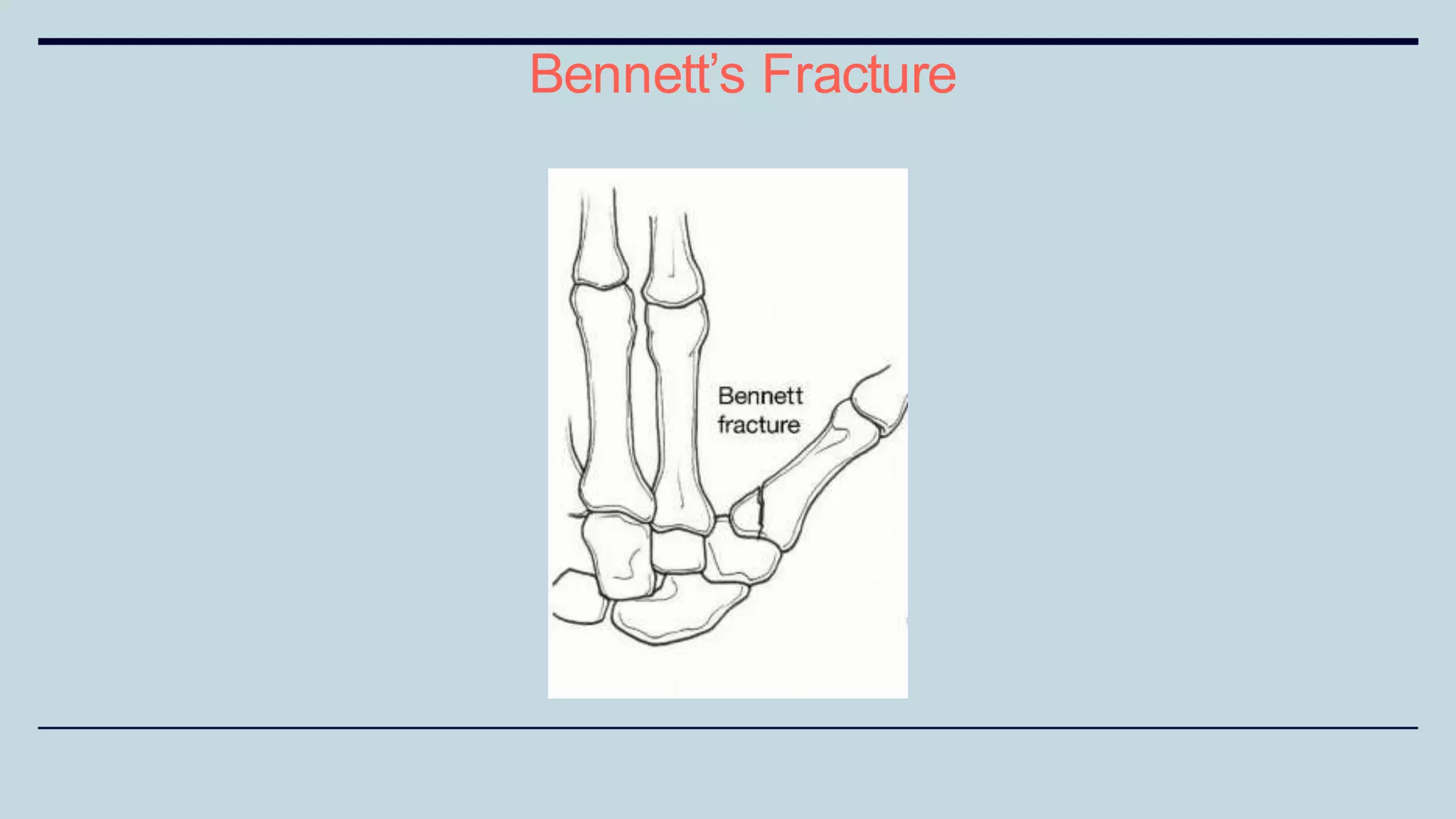 Bennett’s Fracture
 