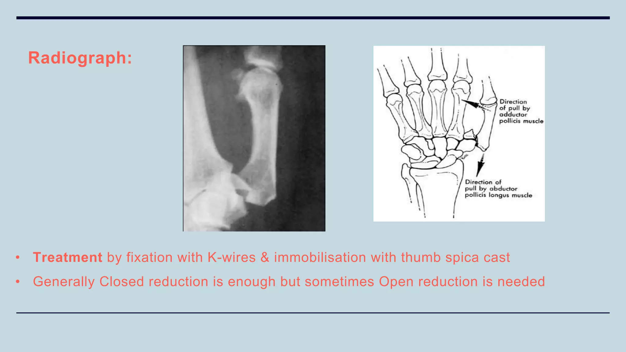 Radiograph:
• Treatment by fixation with K-wires & immobilisation with thumb spica cast
• Generally Closed reduction is enough but sometimes Open reduction is needed
 