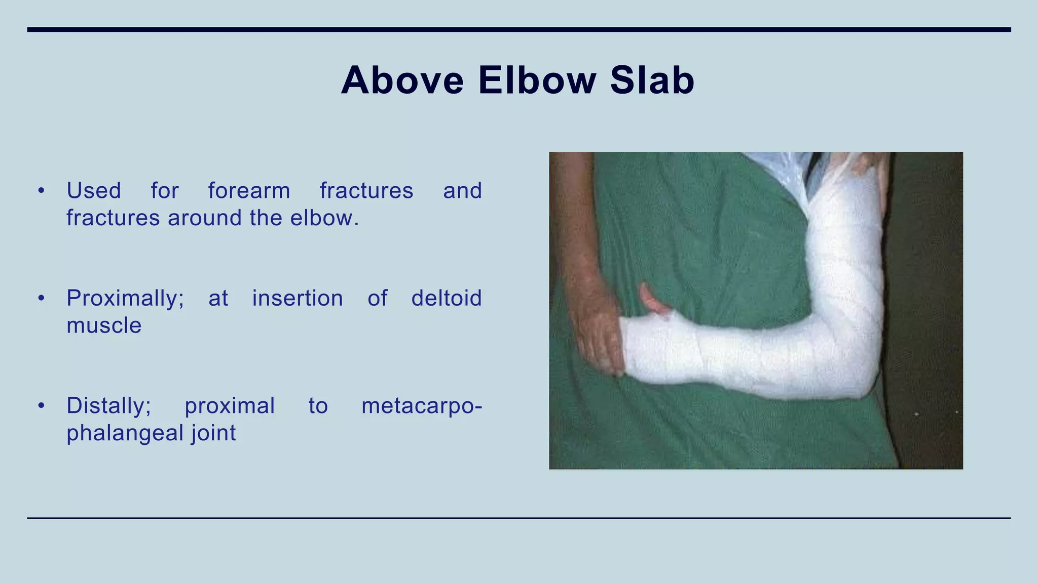 Above Elbow Slab
• Used for forearm fractures and
fractures around the elbow.
• Proximally; at insertion of deltoid
muscle
• Distally; proximal to metacarpo-
phalangeal joint
 