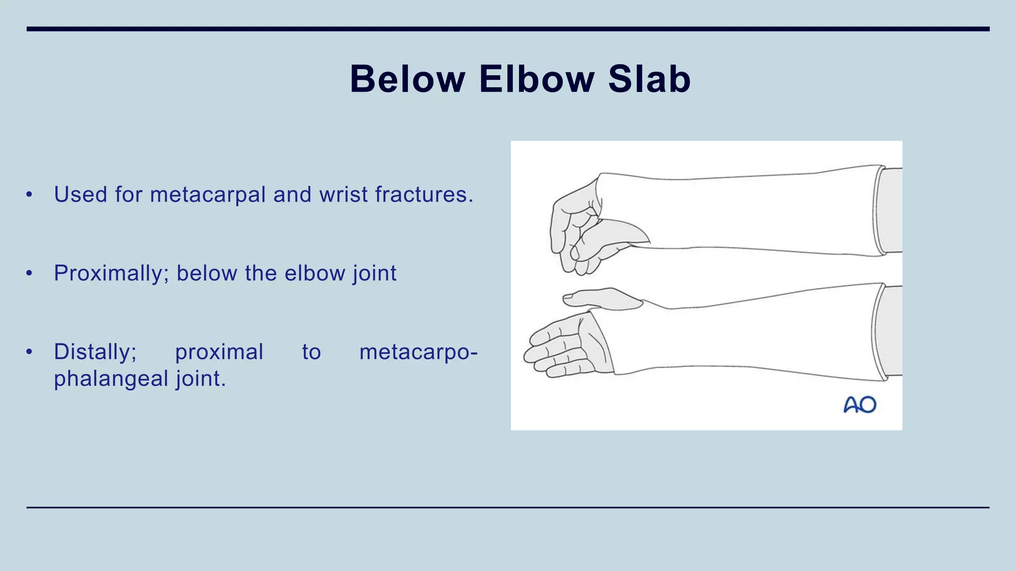Below Elbow Slab
• Used for metacarpal and wrist fractures.
• Proximally; below the elbow joint
• Distally; proximal to metacarpo-
phalangeal joint.
 
