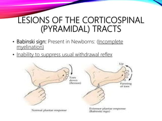 LESIONS OF THE CORTICOSPINAL
(PYRAMIDAL) TRACTS
• Babinski sign: Present in Newborns: (Incomplete
myelination)
• Inability to suppress usual withdrawal reflex
 