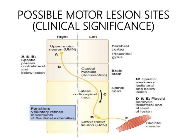 upper motor neuron lesion