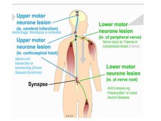 Upper & Lower Motor Neuron Lesions.pptx