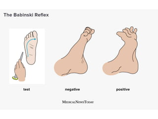 Upper & Lower Motor Neuron Lesions.pptx