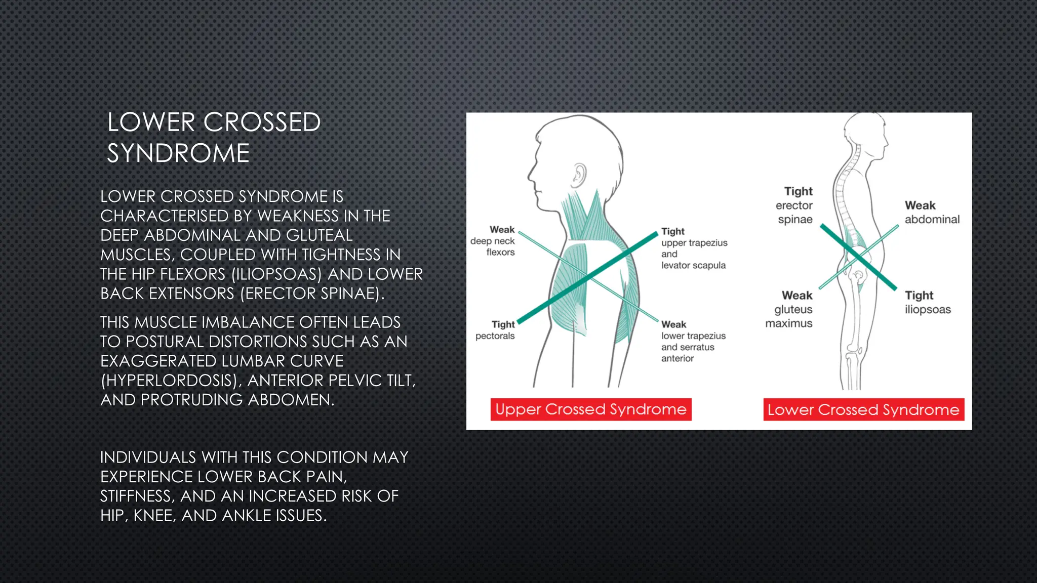 LOWER CROSSED
SYNDROME
LOWER CROSSED SYNDROME IS
CHARACTERISED BY WEAKNESS IN THE
DEEP ABDOMINAL AND GLUTEAL
MUSCLES, COUPLED WITH TIGHTNESS IN
THE HIP FLEXORS (ILIOPSOAS) AND LOWER
BACK EXTENSORS (ERECTOR SPINAE).
THIS MUSCLE IMBALANCE OFTEN LEADS
TO POSTURAL DISTORTIONS SUCH AS AN
EXAGGERATED LUMBAR CURVE
(HYPERLORDOSIS), ANTERIOR PELVIC TILT,
AND PROTRUDING ABDOMEN.
INDIVIDUALS WITH THIS CONDITION MAY
EXPERIENCE LOWER BACK PAIN,
STIFFNESS, AND AN INCREASED RISK OF
HIP, KNEE, AND ANKLE ISSUES.
 