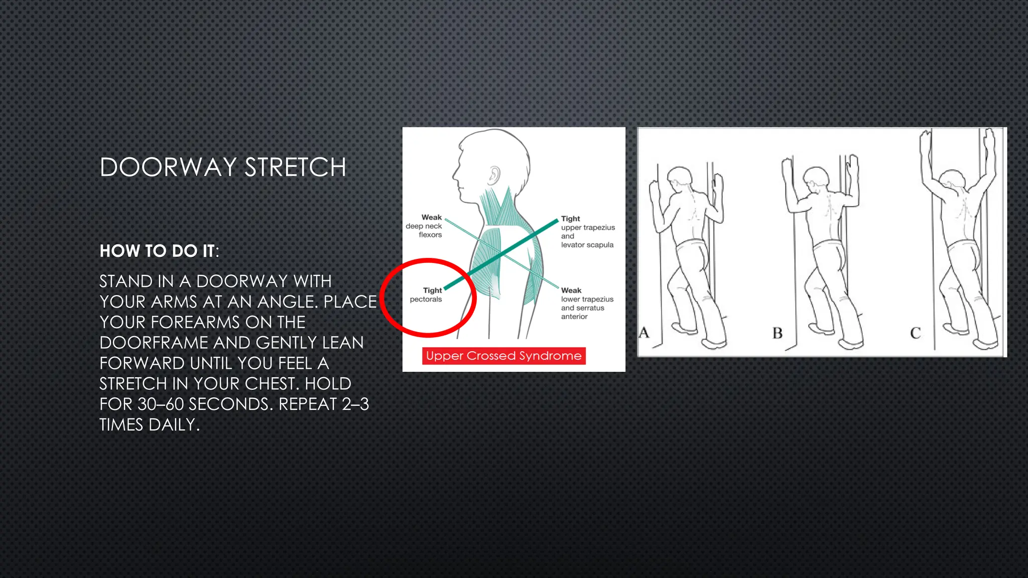 DOORWAY STRETCH
HOW TO DO IT:
STAND IN A DOORWAY WITH
YOUR ARMS AT AN ANGLE. PLACE
YOUR FOREARMS ON THE
DOORFRAME AND GENTLY LEAN
FORWARD UNTIL YOU FEEL A
STRETCH IN YOUR CHEST. HOLD
FOR 30–60 SECONDS. REPEAT 2–3
TIMES DAILY.
 