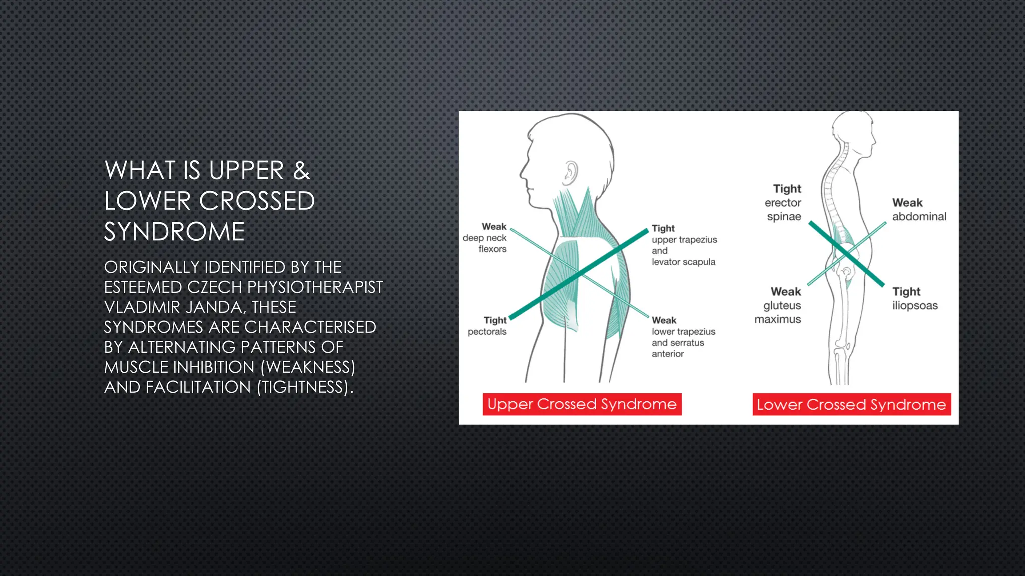 WHAT IS UPPER &
LOWER CROSSED
SYNDROME
ORIGINALLY IDENTIFIED BY THE
ESTEEMED CZECH PHYSIOTHERAPIST
VLADIMIR JANDA, THESE
SYNDROMES ARE CHARACTERISED
BY ALTERNATING PATTERNS OF
MUSCLE INHIBITION (WEAKNESS)
AND FACILITATION (TIGHTNESS).
 