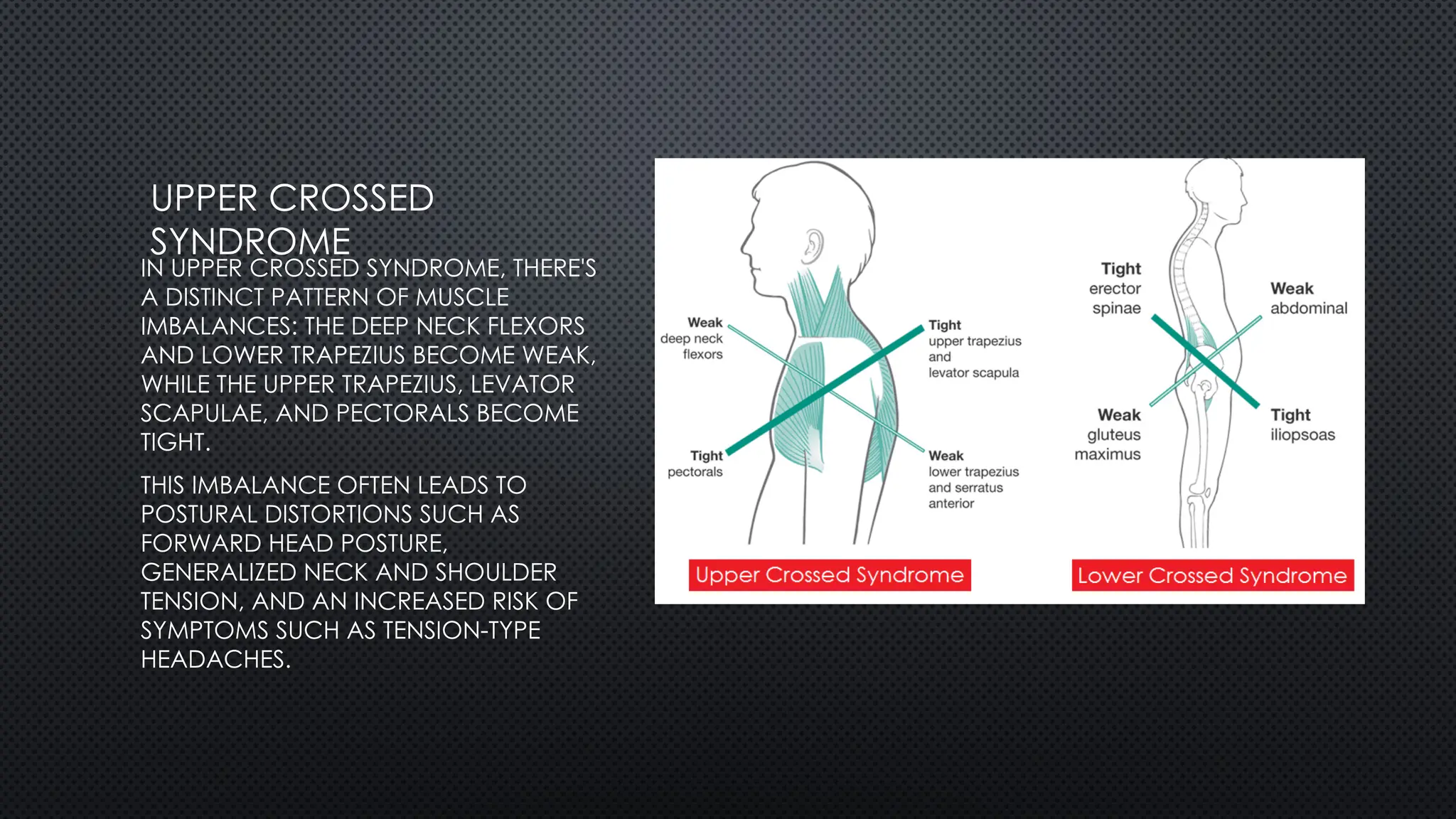 UPPER CROSSED
SYNDROME
IN UPPER CROSSED SYNDROME, THERE'S
A DISTINCT PATTERN OF MUSCLE
IMBALANCES: THE DEEP NECK FLEXORS
AND LOWER TRAPEZIUS BECOME WEAK,
WHILE THE UPPER TRAPEZIUS, LEVATOR
SCAPULAE, AND PECTORALS BECOME
TIGHT.
THIS IMBALANCE OFTEN LEADS TO
POSTURAL DISTORTIONS SUCH AS
FORWARD HEAD POSTURE,
GENERALIZED NECK AND SHOULDER
TENSION, AND AN INCREASED RISK OF
SYMPTOMS SUCH AS TENSION-TYPE
HEADACHES.
 
