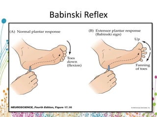 Babinski Reflex