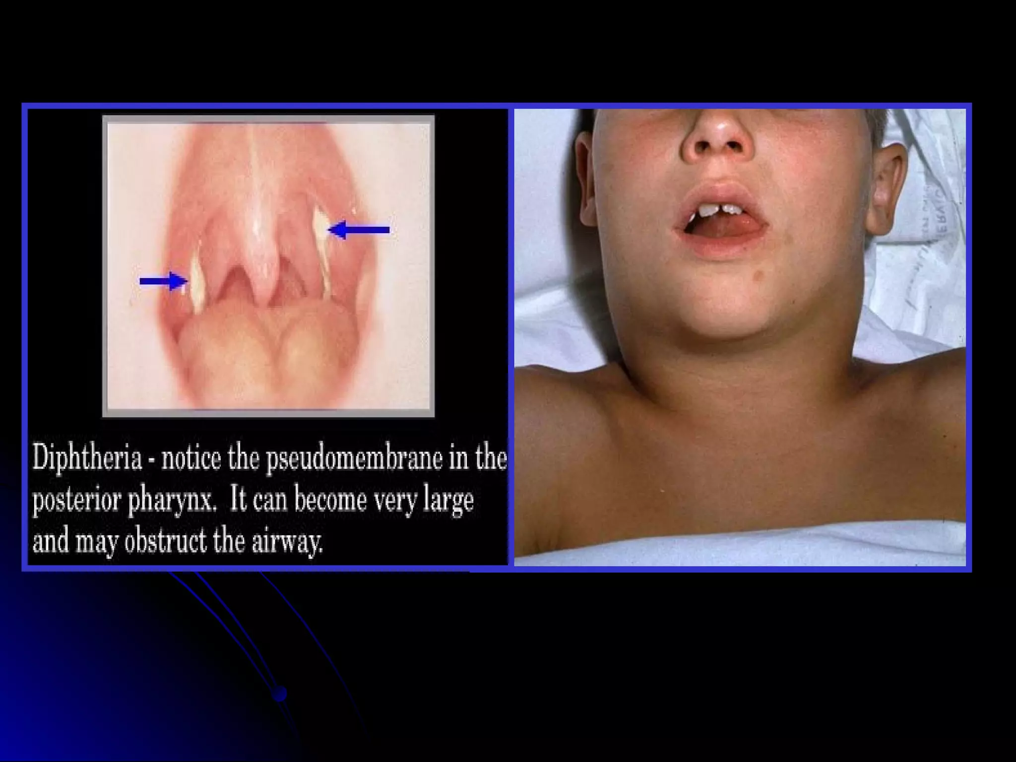 Upper respiratory infections in children | PPT