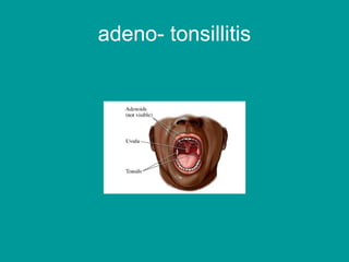 adeno- tonsillitis
 