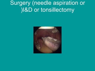 Surgery (needle aspiration or
I&D or tonsillectomy(
 