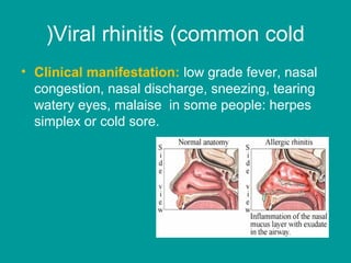Viral rhinitis (common cold(
• Clinical manifestation: low grade fever, nasal
congestion, nasal discharge, sneezing, tearing
watery eyes, malaise in some people: herpes
simplex or cold sore.
 