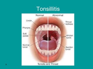 Tonsillitis
9
 