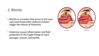 Eye Rhinitis Upper Respiratory Infections and management ppt | PPTX