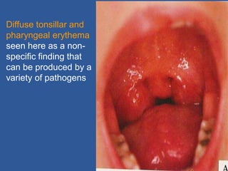 Diffuse tonsillar and
pharyngeal erythema
seen here as a non-
specific finding that
can be produced by a
variety of pathogens
 