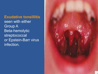 Exudative tonsillitis
seen with either
Group A
Beta-hemolytic
streptococcal
or Epstein-Barr virus
infection.
 