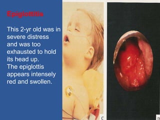 Epiglottitis
This 2-yr old was in
severe distress
and was too
exhausted to hold
its head up.
The epiglottis
appears intensely
red and swollen.
 
