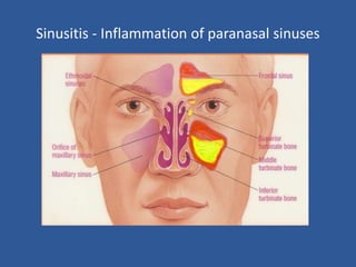 Sinusitis - Inflammation of paranasal sinuses
 