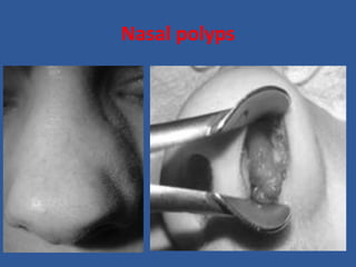Nasal polyps
 