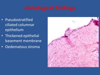 Histological findings
• Pseudostratified
ciliated columnar
epithelium
• Thickened epithelial
basement membrane
• Oedematous stroma
 