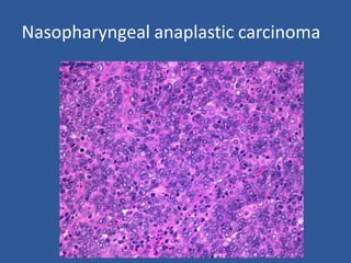 Nasopharyngeal anaplastic carcinoma
 