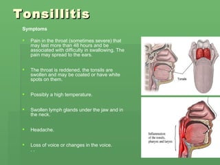 Tonsillitis Symptoms Pain in the throat (sometimes severe) that may last more than 48 hours and be associated with difficulty in swallowing. The pain may spread to the ears. The throat is reddened, the tonsils are swollen and may be coated or have white spots on them. Possibly a high temperature. Swollen lymph glands under the jaw and in the neck. Headache. Loss of voice or changes in the voice.  . .  
