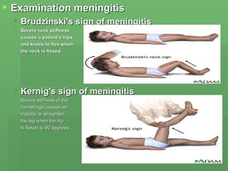 Examination meningitis Brudzinski's sign of meningitis  Severe neck stiffness  causes a patient's hips  and knees to flex when  the neck is flexed.   Kernig's sign of meningitis   Severe stiffness of the  hamstrings causes an  inability to straighten  the leg when the hip  is flexed to 90 degrees.  