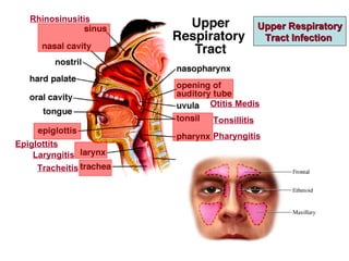 Upper RespiratoryUpper Respiratory
Tract InfectionTract Infection
Rhinosinusitis
Otitis Medis
Epiglottits
Laryngitis
Tracheitis
Tonsillitis
Pharyngitis
 