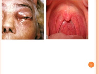 Upper respiratory tract infections | PDF
