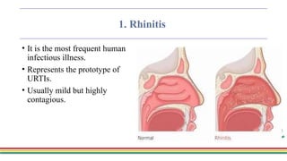 Mild Rhinitis Upper Respiratory Tract Infections Pharmacotherapy | PPTX
