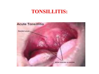 CAUSES:
• Inflammation of the tonsils may result from
bacterial or viral infections.
• Bacterias: Tonsillitis is often cau...