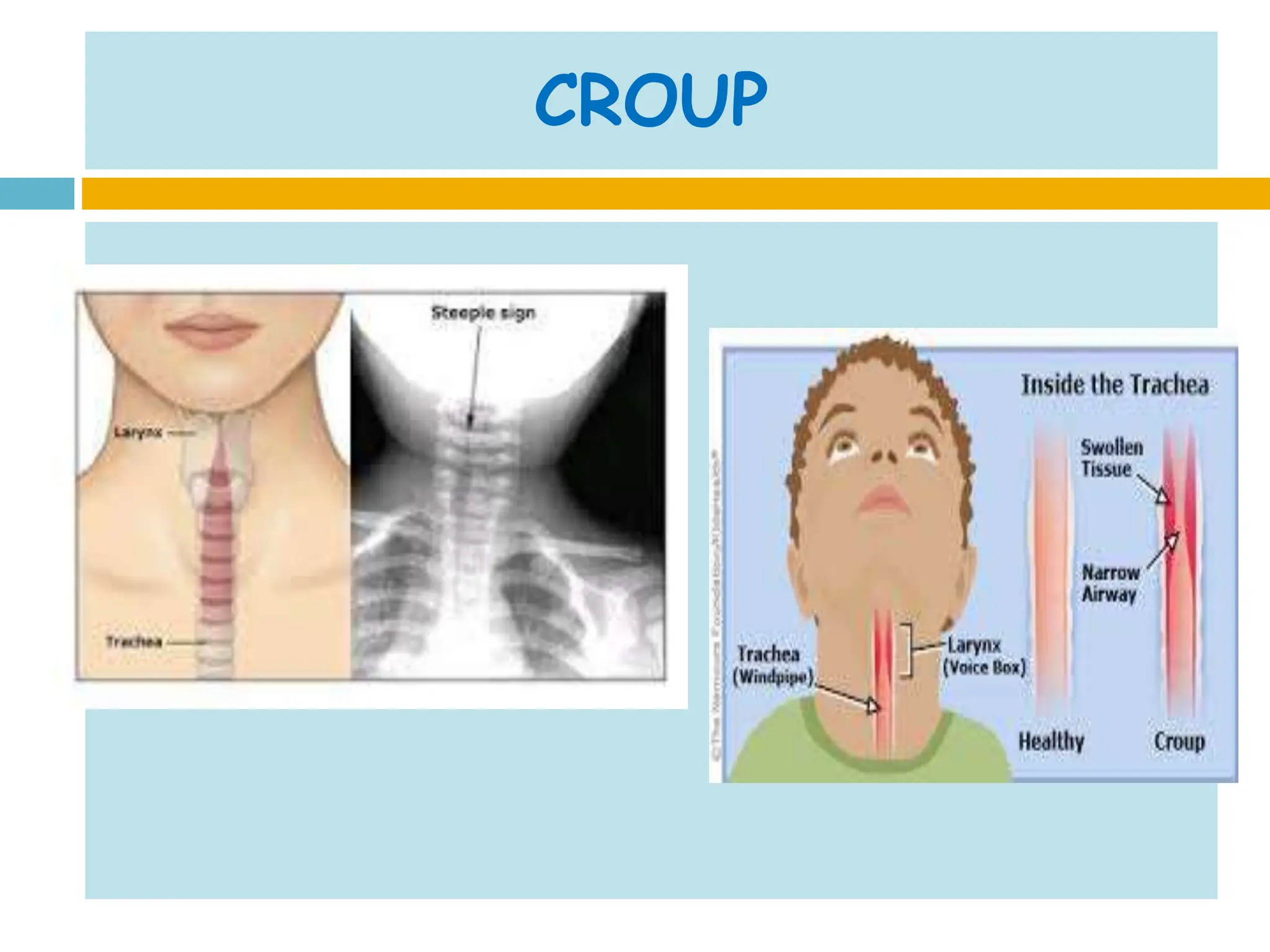 Upper respiratory tract infection in pediatrics | PPTX